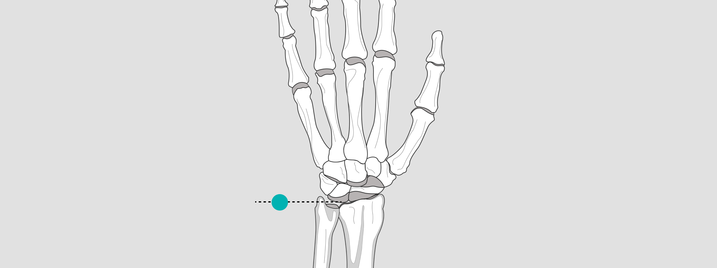 How to do Xray calibration from markers to magnification